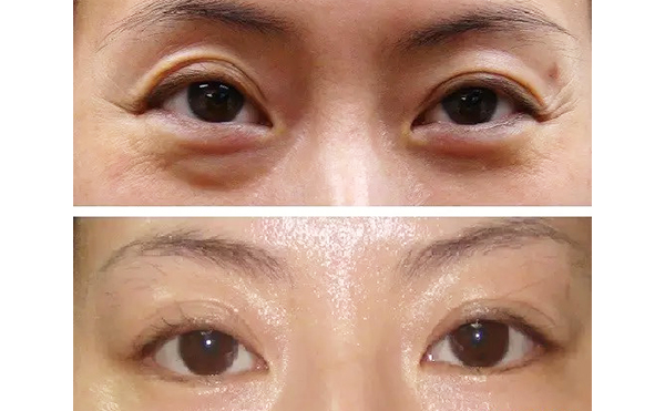 魚尾紋是怎么引起的？