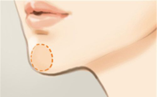 下巴整形恢復(fù)期要多久？