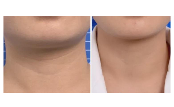 頸紋是怎么形成的？