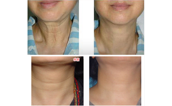 激光去除頸紋有什么優(yōu)勢？