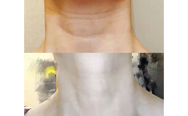 嗨體可以長期使用嗎？