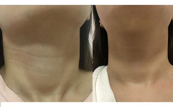 嗨體去頸紋會(huì)反彈嗎？