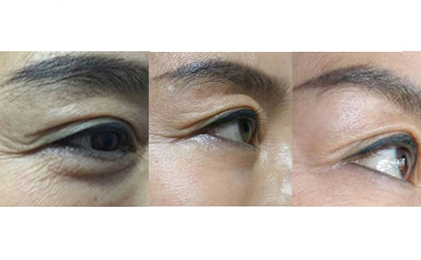 膠原蛋白除皺是什么原理？