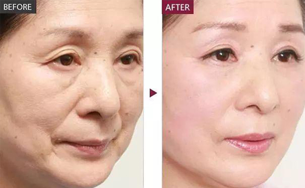 膠原蛋白除皺的適應(yīng)人群？