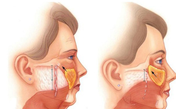 筋膜懸吊除皺是什么原理？