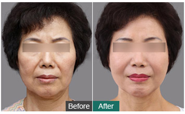 筋膜除皺提升有什么優(yōu)勢？