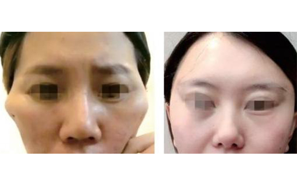 筋膜懸吊除皺有什么副作用？