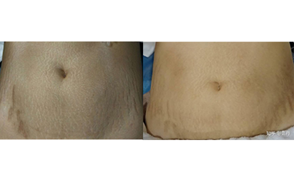 激光去妊娠紋有哪些優(yōu)勢？