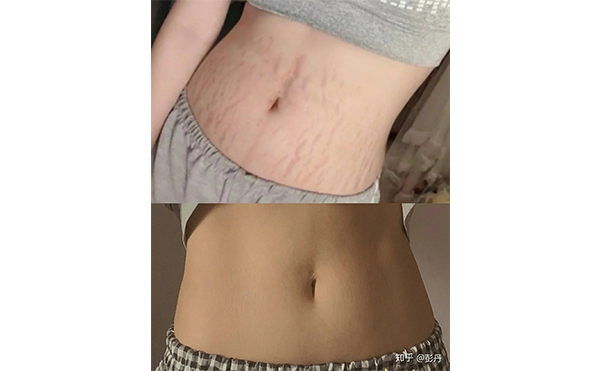 激光去妊娠紋安全嗎？