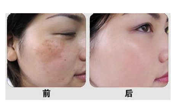 光子嫩膚有什么優(yōu)勢(shì)？