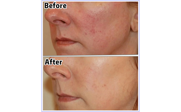 光子嫩膚會(huì)讓皮膚變薄嗎？