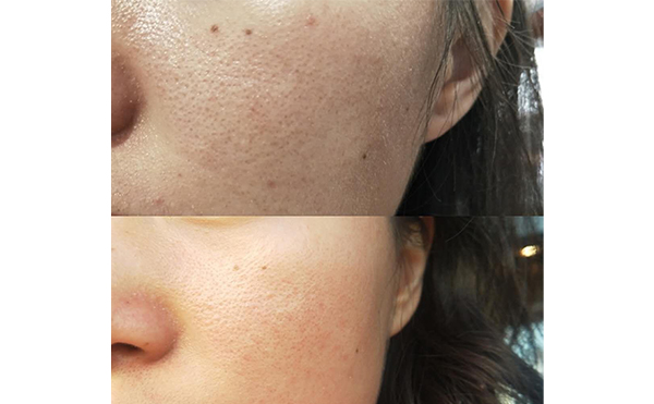 果酸煥膚的原理是什么?效果怎么樣?