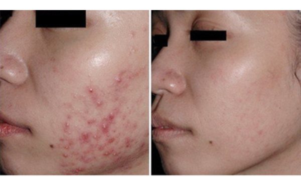 果酸煥膚好不好？