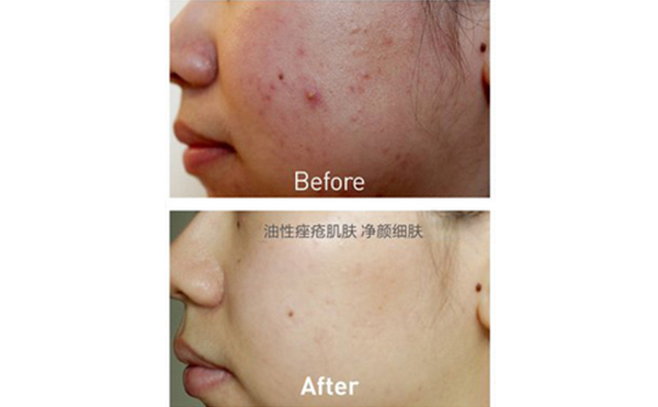 果酸煥膚能維持多久？