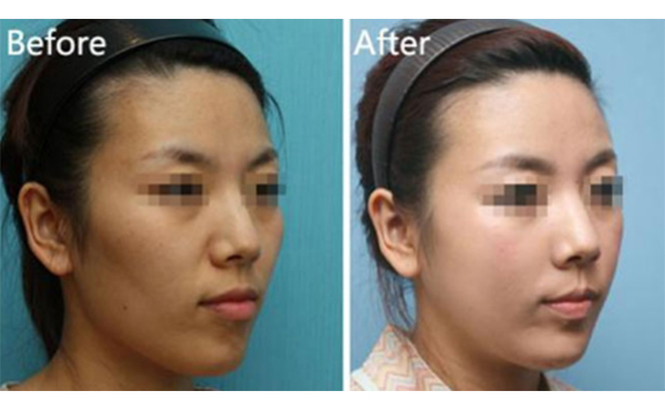 美白針一針多少錢？