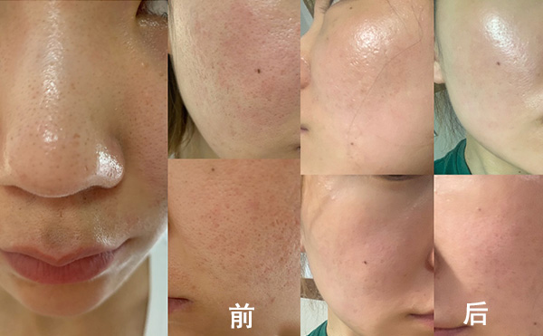 無針水光有什么優(yōu)勢？