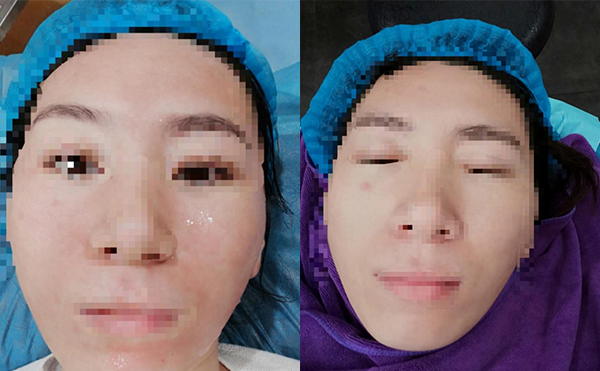 敏感肌能做水光針嗎？