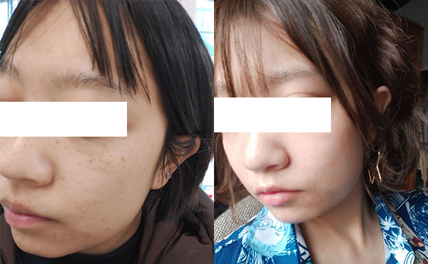 激光祛斑效果好不好？