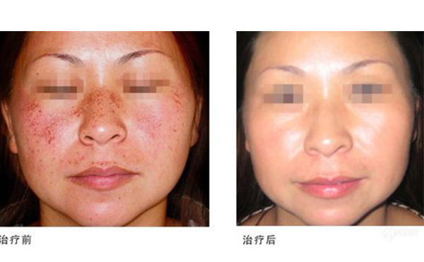 激光祛斑多少錢(qián)？