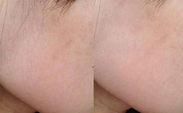 冰點面部脫毛的價格多少?費用貴不貴?