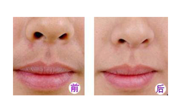 冰點(diǎn)脫毛好不好？