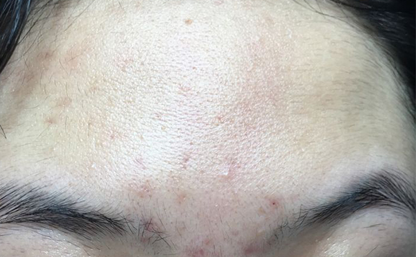 冰點(diǎn)脫毛有什么缺點(diǎn)嗎？