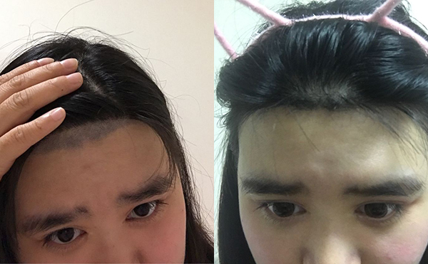 激光脫毛安全嗎？