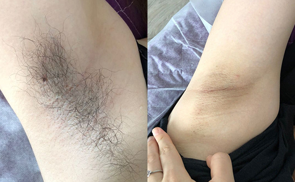 光子脫毛多少錢(qián)?價(jià)格跟哪些因素有關(guān)?