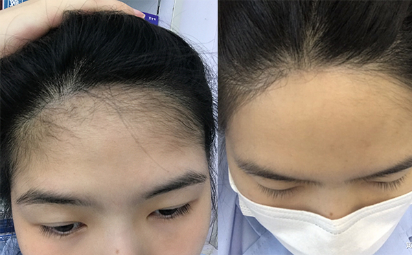 激光脫發(fā)際線的過(guò)程是什么？