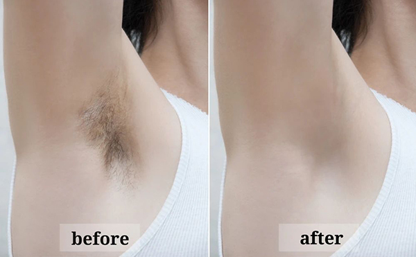 激光脫腋毛效果怎么樣？