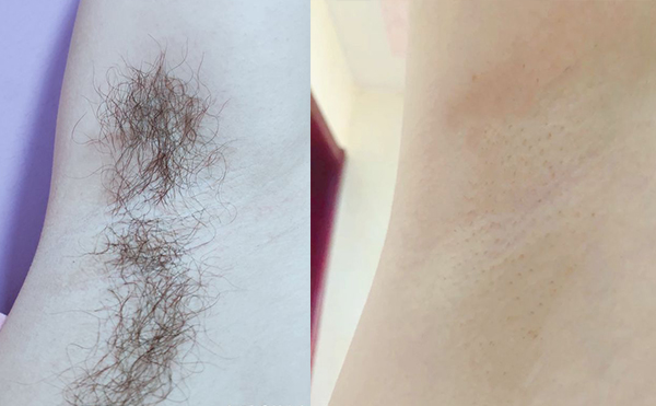 冰點(diǎn)脫腋毛要脫幾次？