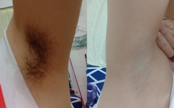 冰點(diǎn)脫腋毛過(guò)程是什么？