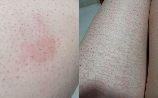 錯誤脫毛有什么后果？