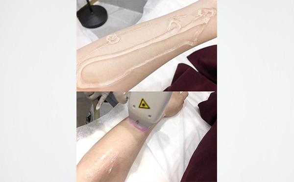 激光手臂脫毛是怎么做的？