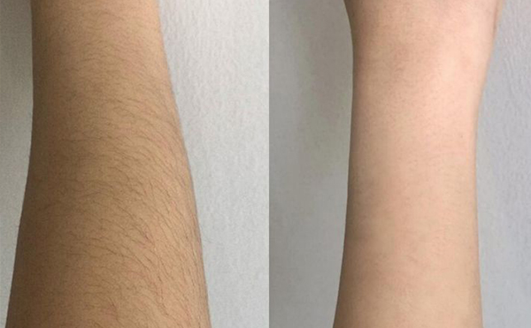 脫毛會影響新陳代謝嗎？