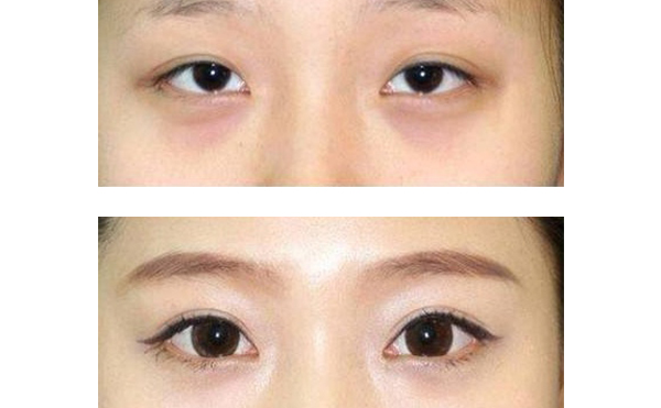 眼綜合和隆鼻可以一起做嗎？