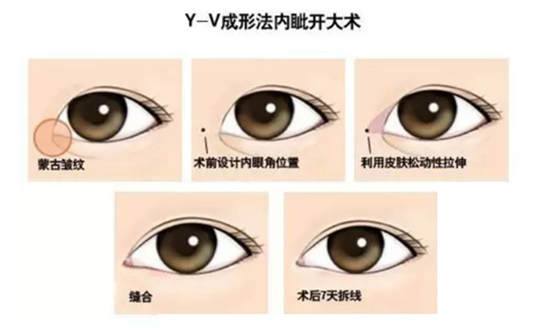 開內(nèi)眼角復(fù)雜嗎?手術(shù)過程是什么?