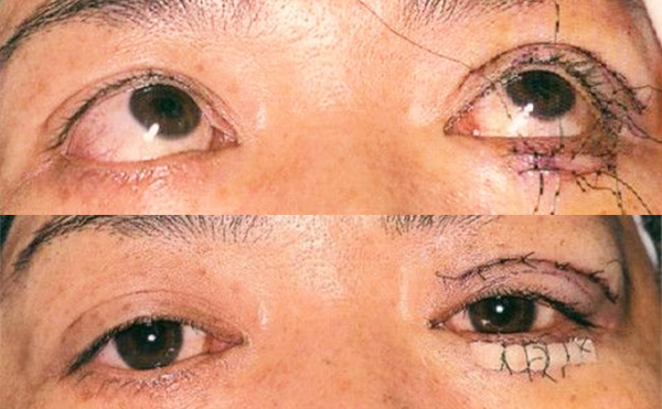 眼瞼缺損什么原因?眼瞼缺損怎么辦?