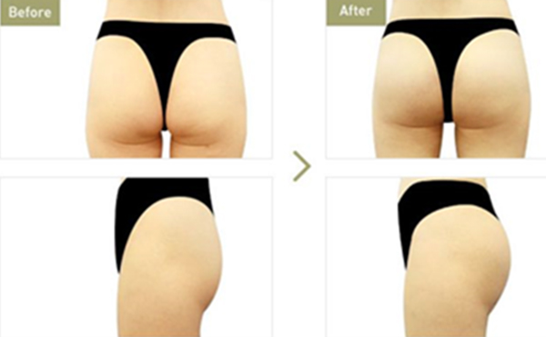 豐臀和提臀有什么區(qū)別?提臀有什么風(fēng)險(xiǎn)?