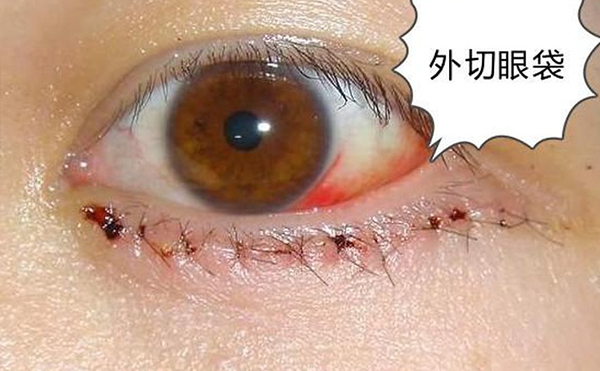 去眼袋術(shù)后出現(xiàn)眼瞼外翻是什么原因?怎么修復(fù)?