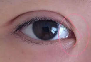 內(nèi)眥贅皮過(guò)多
