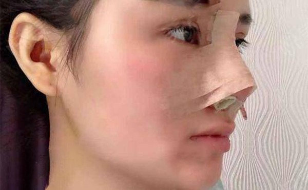 硅膠假體隆鼻硅膠取出后要注意些什么?