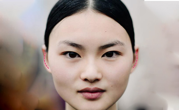 太陽穴凹陷怎么辦?