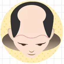 七級(jí)脫發(fā)