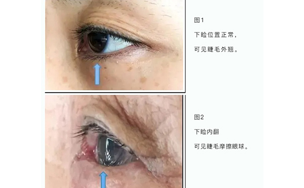 老年人眼瞼內翻原因有哪些?老年人眼瞼內翻怎樣治療?