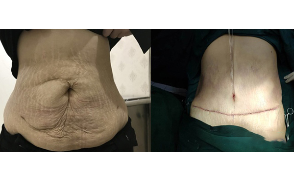 腹壁成形術(shù)的手術(shù)方式是什么?適合哪些人?