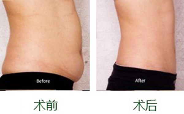 產(chǎn)后減肥可以做腹部吸脂嗎？