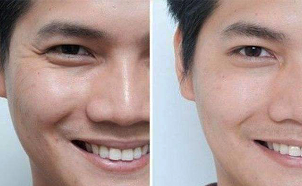 玻尿酸眼部除皺效果怎么樣？