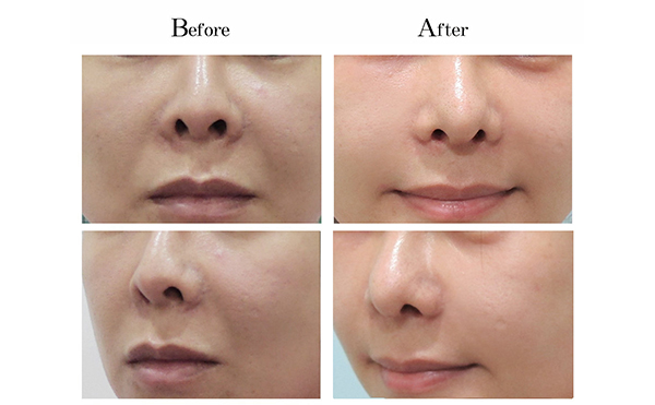 玻尿酸去法令紋有什么優(yōu)勢(shì)？