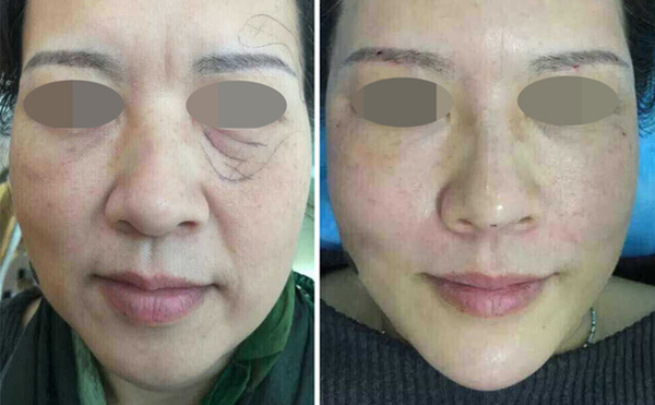 筋膜懸吊安全嗎？